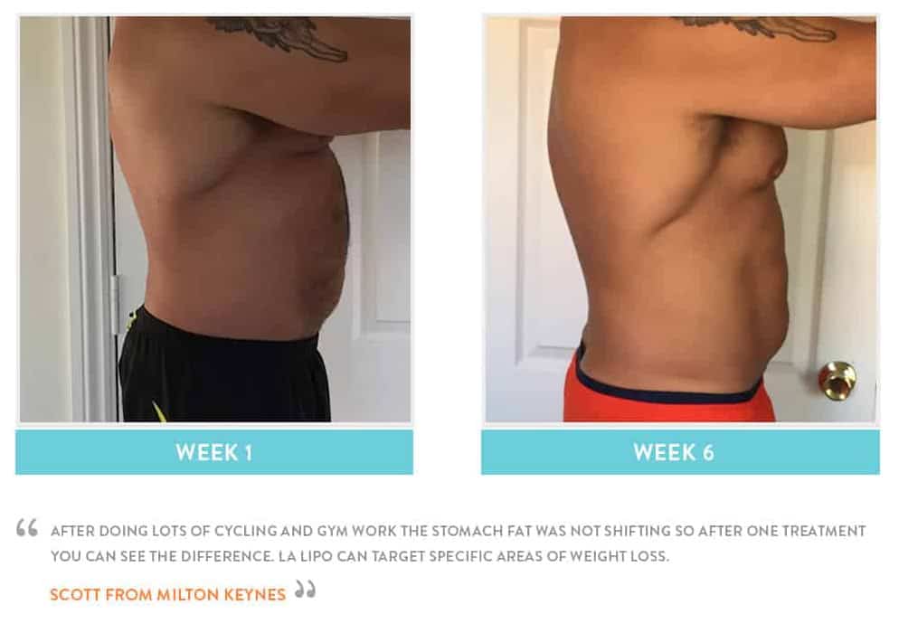 Before & After Stomach Fat Peterborough
