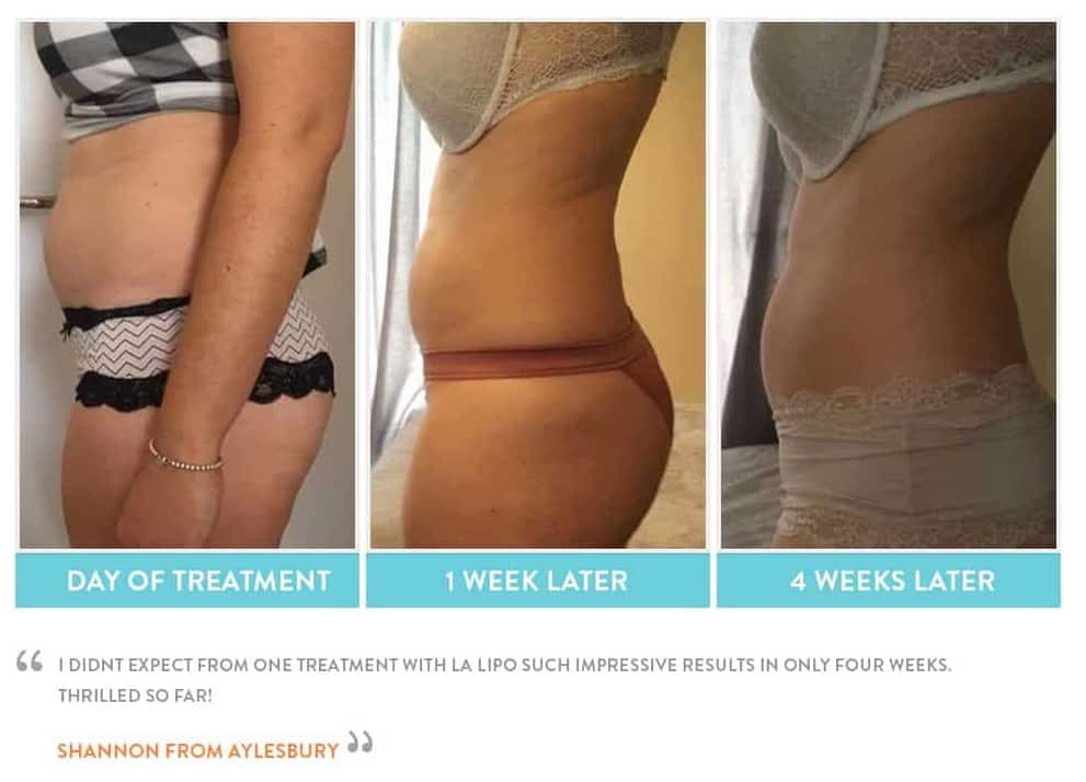 before, Cryolipolysis Peterborough