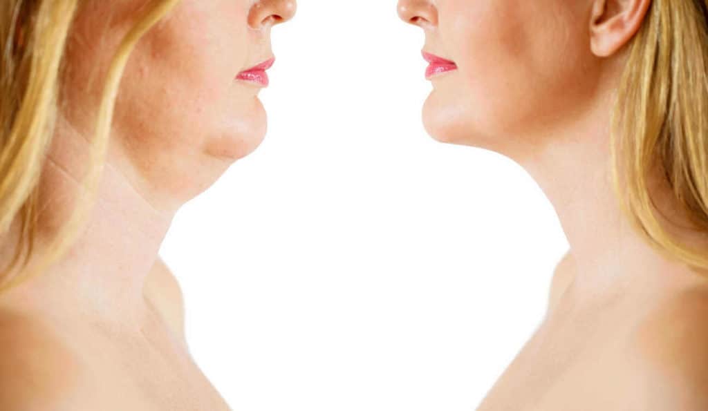 Double Chin treatment Peterborough before and after results