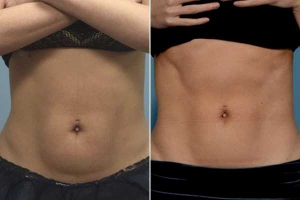 body sculpting FAQs Peterborough