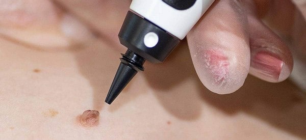 After Skin Tag Removal Peterborough