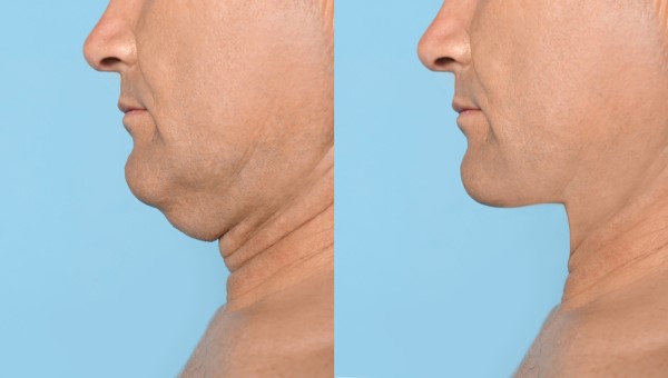Which Non-Surgical Treatments Work Best for Jowls and Loose Skin Peterborough?