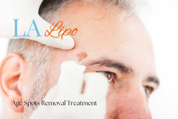 What Are the Most Effective Treatments for Age Spots Peterborough?