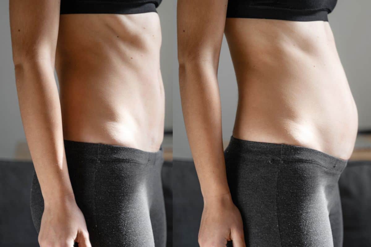 How long does diastasis recti take to improve Peterborough?