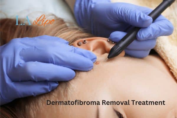 Dermatofibroma Removal Treatment Peterborough