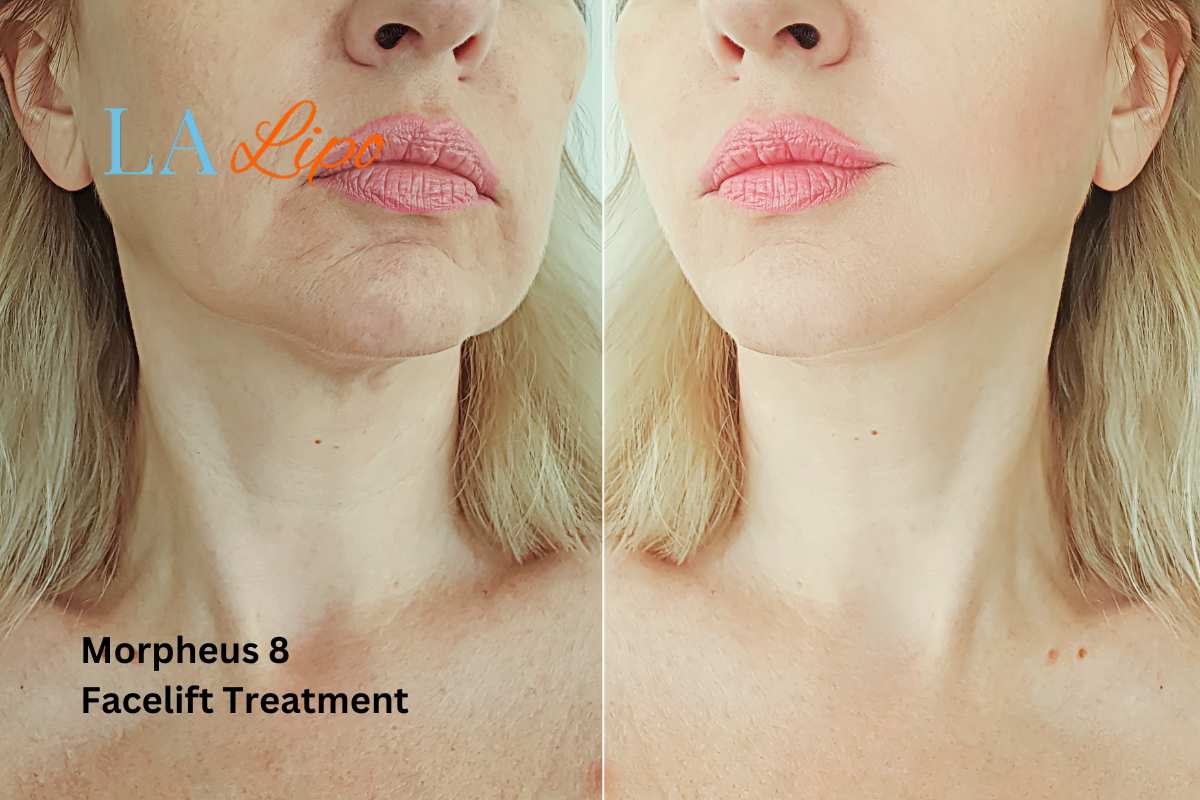 Turn back time with Morpheus8 Treatment Peterborough