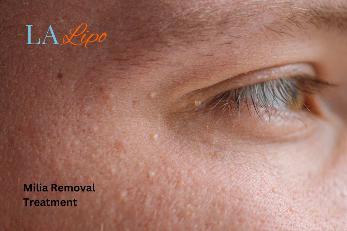 Cryopen Milia Removal: Is It the Easiest and Safest Option Peterborough?