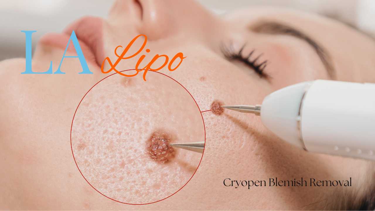 cryopen blemish removal Peterborough Contact our team today!