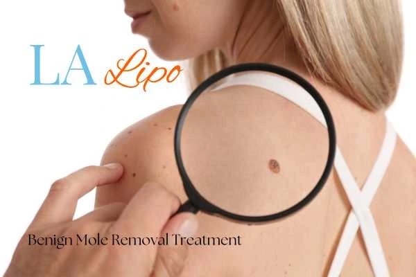 Why getting moles removed Peterborough can boost your confidence!