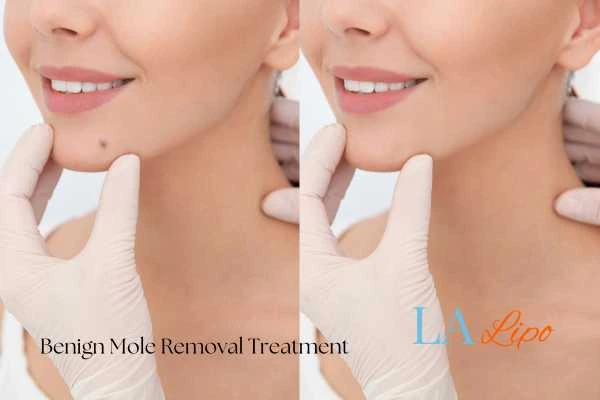Woman's before and after results of being moles removal treatment Peterborough