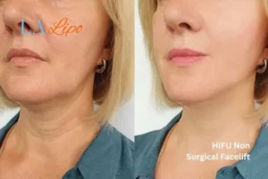 hi-fu for wrinkles Peterborough before and after results