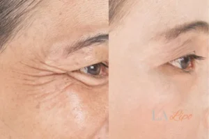 Before and after results of woman - HI-fu wrinkles reduction treatment Peterborough
