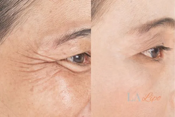 Before and after results of woman - HI-fu wrinkles reduction treatment Peterborough