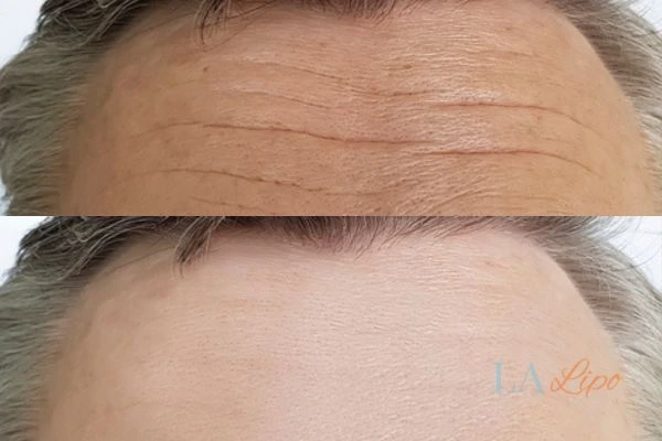 results of HIFU Peterborough on mans forehead to help reduce lines and wrinkles
