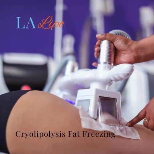 fat freezing - Cryolipolysis Peterborough