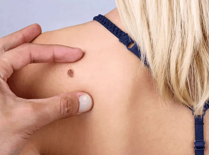 woman having mole removal Peterborough consultation before treatment.