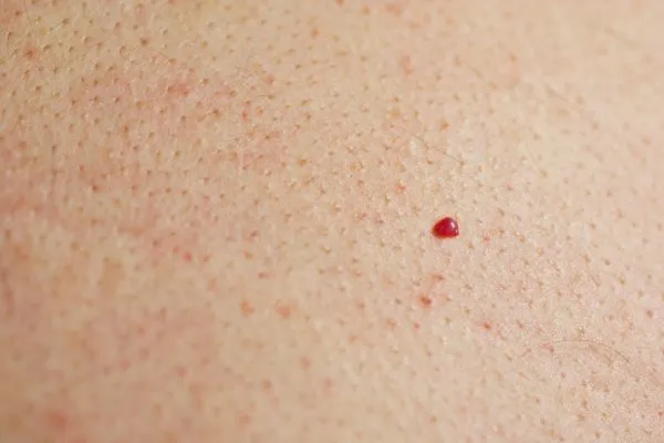 close up of a cherry angioma Peterborough