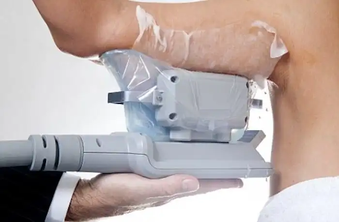 Picture of fat freezing Peterborough on the upper arms.