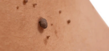 image of a skin tag Peterborough