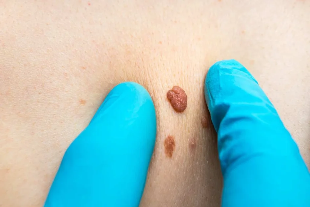 Consultant examining a skin tag Peterborough