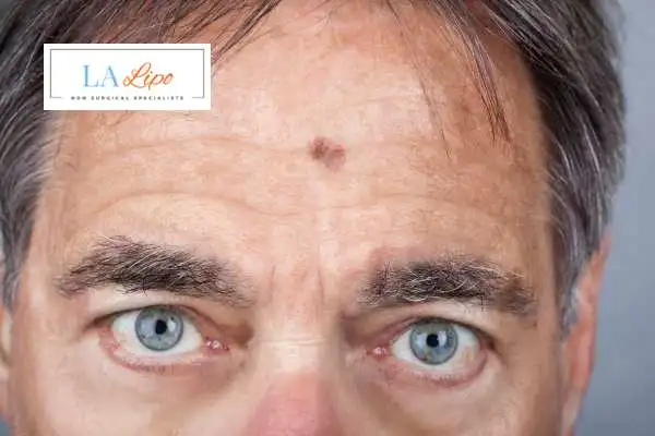Solar Lentigo Removal Peterborough image of man with mark on his forehead