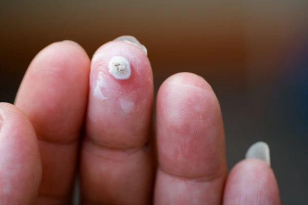 wart on person finger - cryotherapy to treat from LA LIPO Peterborough