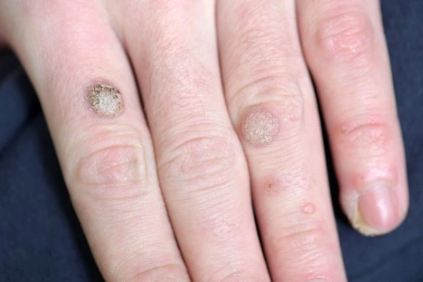 photo of warts on person hand - see wart removal Peterborough from LA LIPO