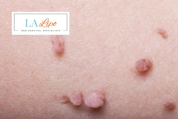 Does cryopen skin tag removal Peterborough hurt? Find out now call our team today!