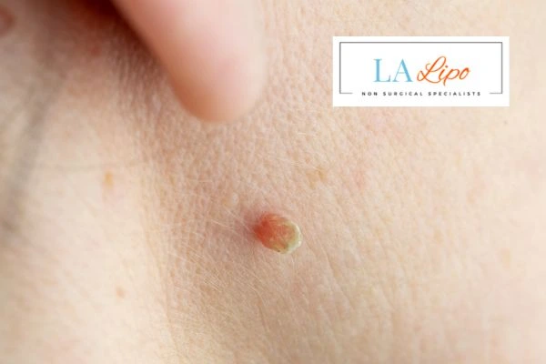 Book skin tag removal Peterborough today speak to our team now!