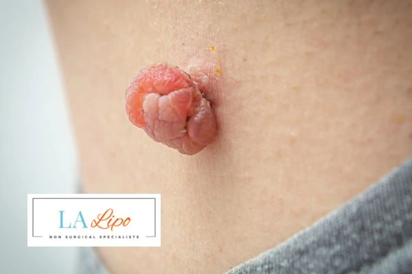 Interested in skin tag removal Peterborough? Concerned about the pain? Find out more today!