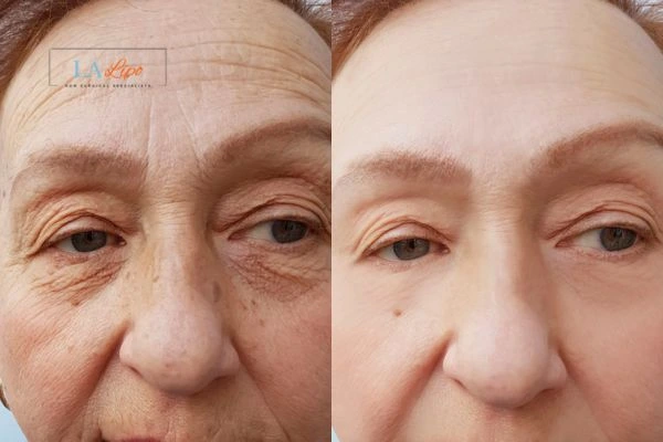 The powerful benefits of Morpheus8 Treatment Peterborough - Call Our team today!