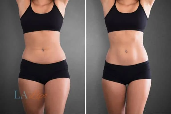 before and after results of non-surgical treatment to help a woman's body image and mental health Peterborough