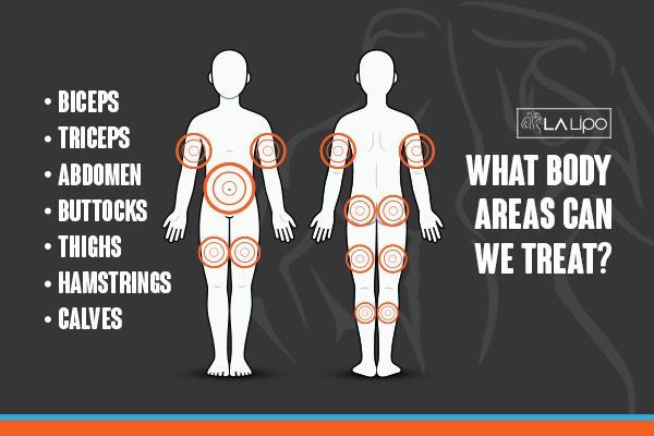 Diagram to show areas you can have LA-EMS Body Sculpting Treatment Peterborough