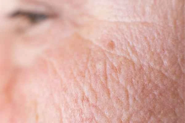 close up picture of a woman's face showing an age spot Peterborough