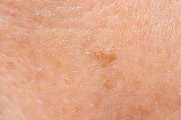 close up picture of age spots Peterborough
