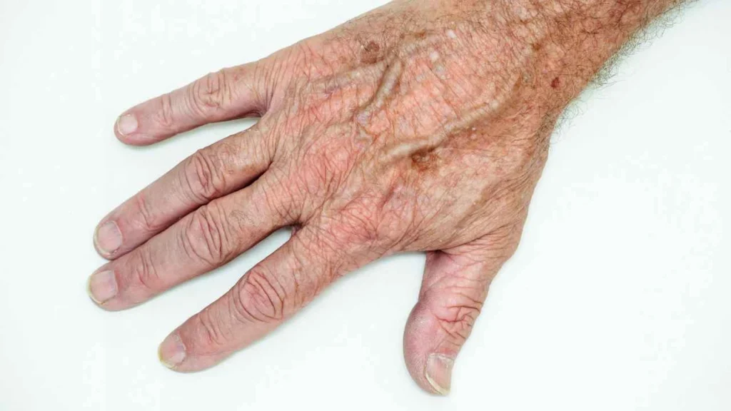 Male hand showing age spot Peterborough