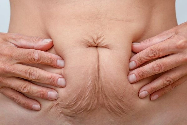 Image of a woman's stomach with loose skin - example of skin tightening Peterborough options