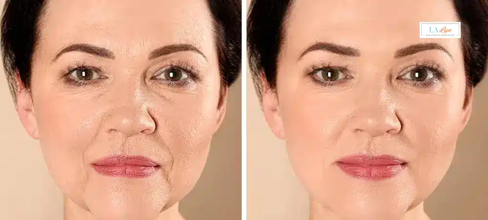 How Long Does It Take to See Results and How Long Do They Last Peterborough?
