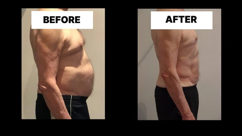 What Symptoms Can Diastasis Recti Cause in Men? Weak Core, Back Pain and Poor Posture Peterborough